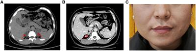 Case Report: A combination of chimeric CYP11B2/CYP11B1 and a novel p.Val68Gly CYP11B1 variant causing 11β-Hydroxylase deficiency in a Chinese patient